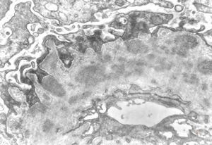 M,13y. | type III membranoproliferative glomerulonephritis M,13y. | type III membranoproliferative glomerulonephritis